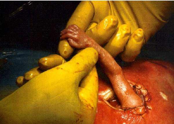 En una cirujía, un bebé le da la mano al cirujano.