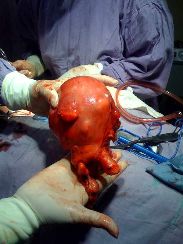 Histerectomía (Remoción total quirúrgica del utero)