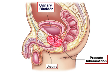 Prostate Inflammation